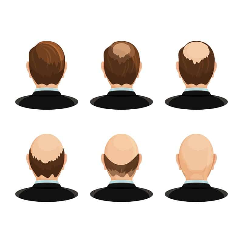 men's baldness