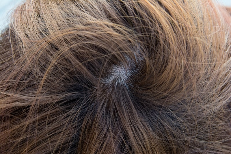 why does your hair hurt