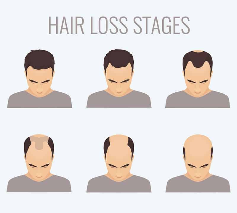 Mens Hair Loss and Baldness