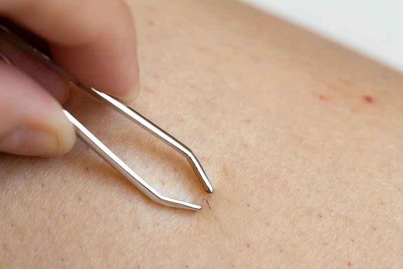 how to get rid of ingrown hair bumps