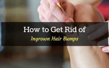 how to get rid of ingrown hair cyst