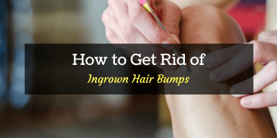 how to get rid of ingrown hair cyst
