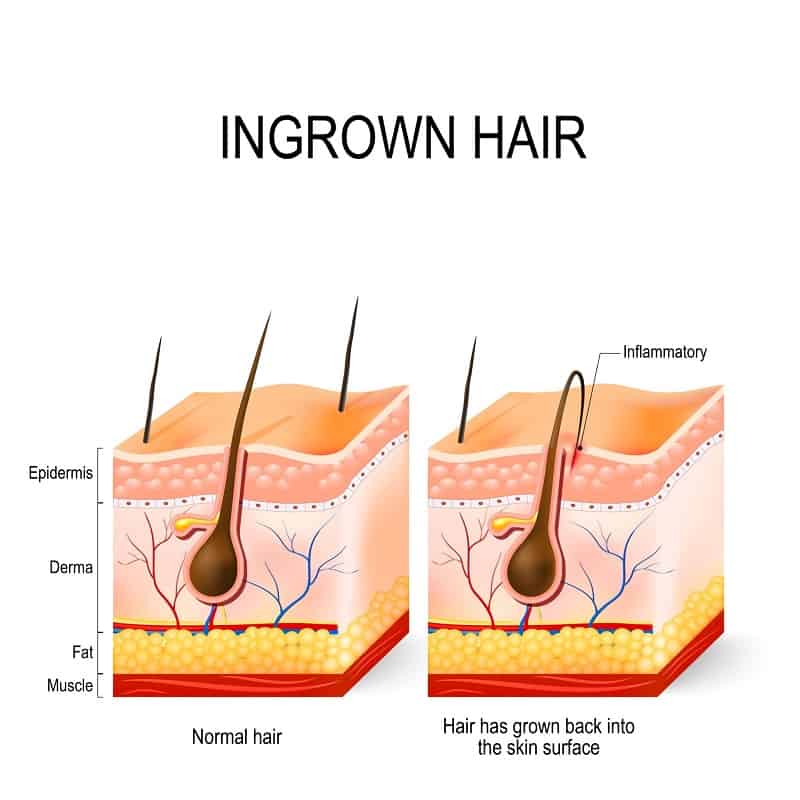 what is an ingrown hair
